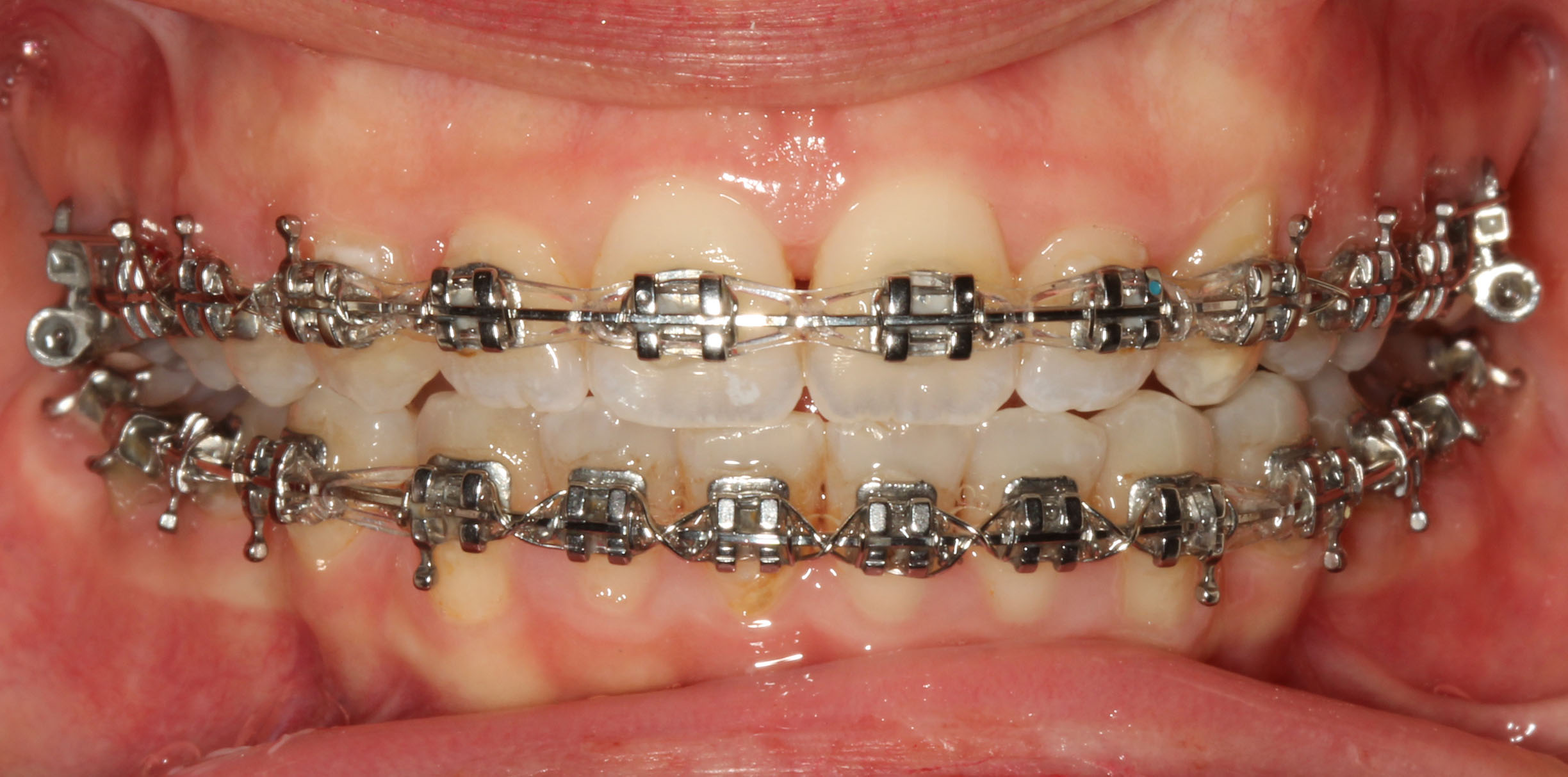 Metal Braket 2